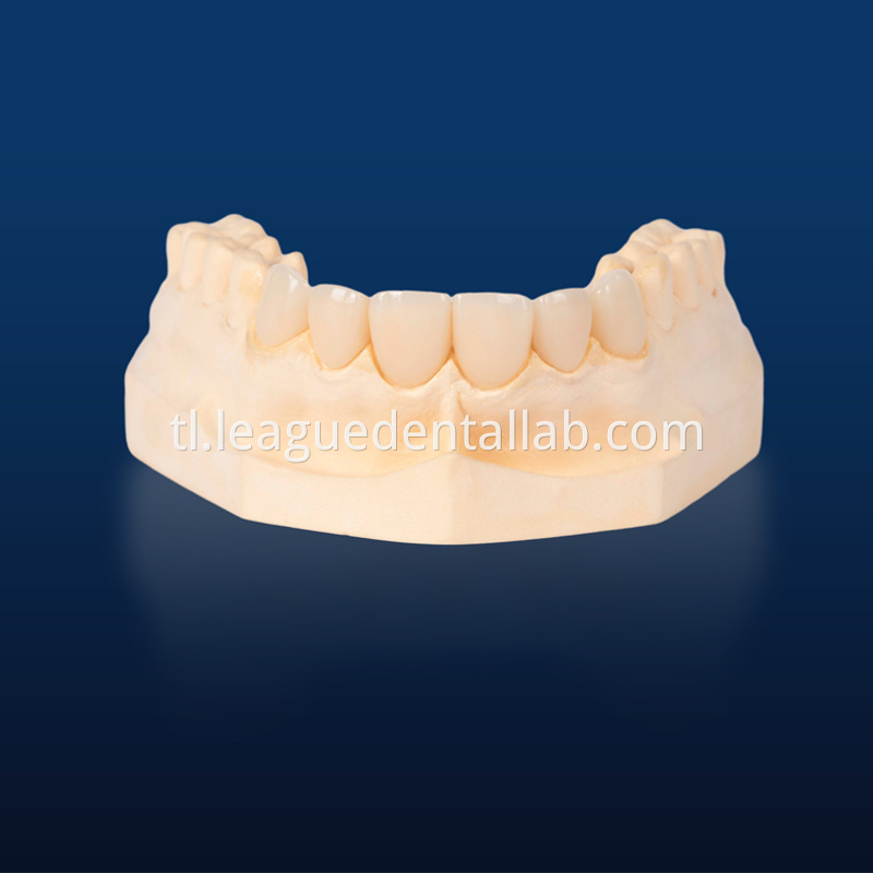 IPS Empress,Emax Onlay,Emax onlay,Emax Veneer,Lithium disilicate